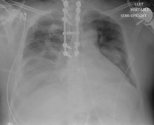 CXR