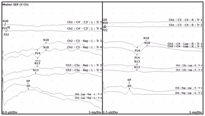 SSEP waveforms