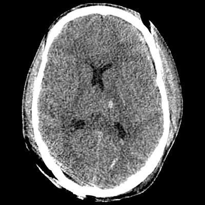 Non-contrast head CT demonstrating IVH, DAI, scalp hematoma