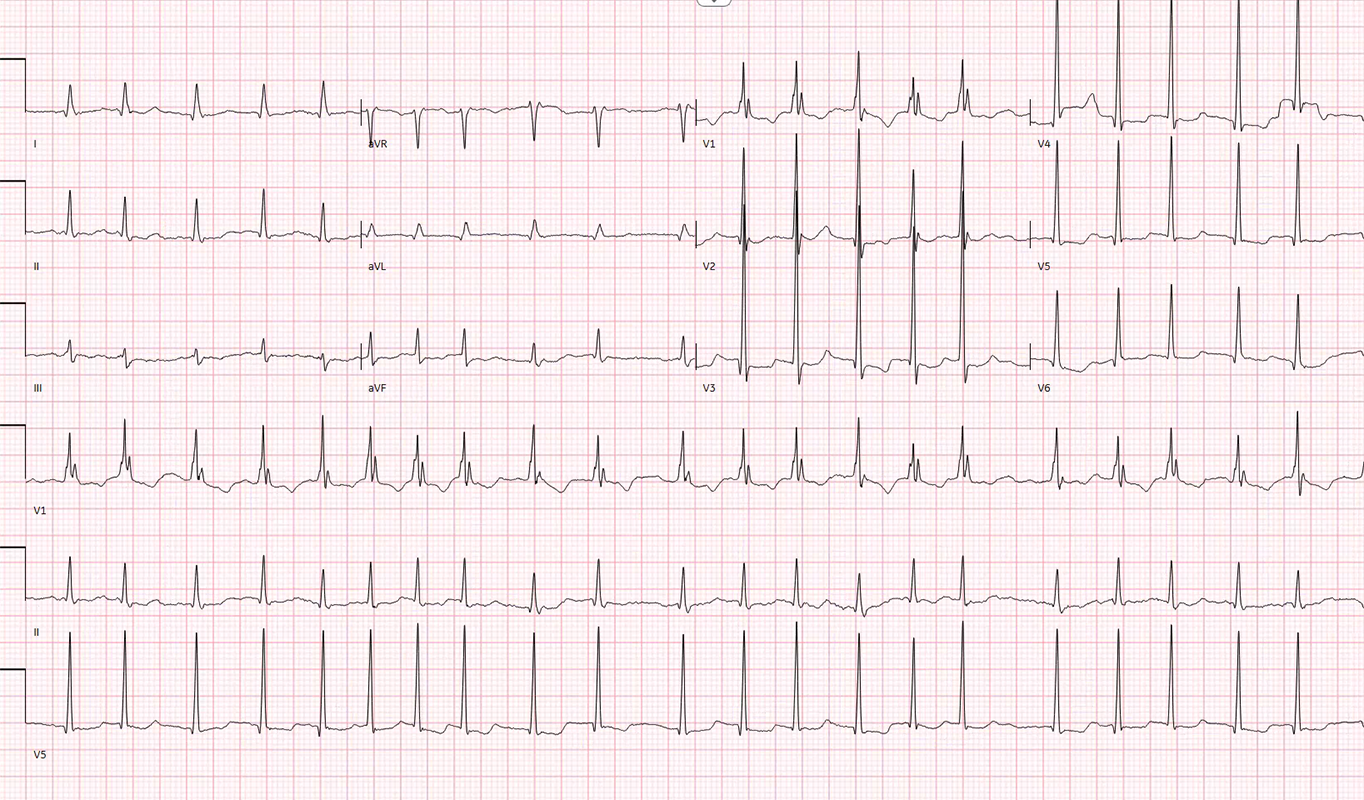 Abnormal ECG