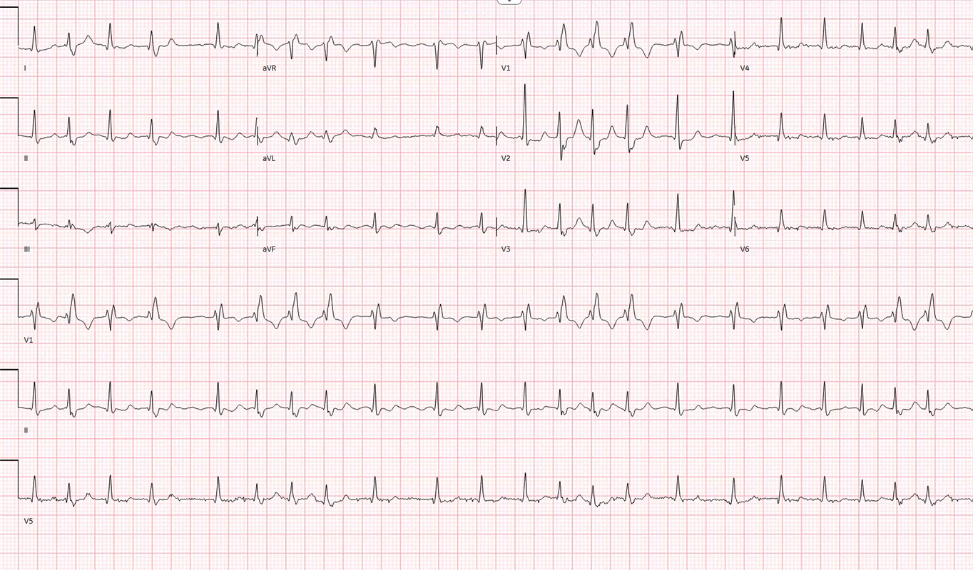 ECG