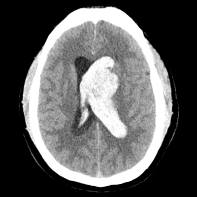 HCT showing L caudate IPH with IVH