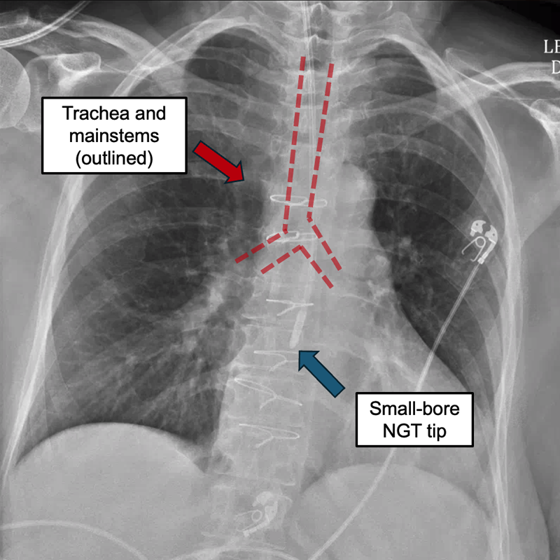 Annotated chest X-ray with NGT placed