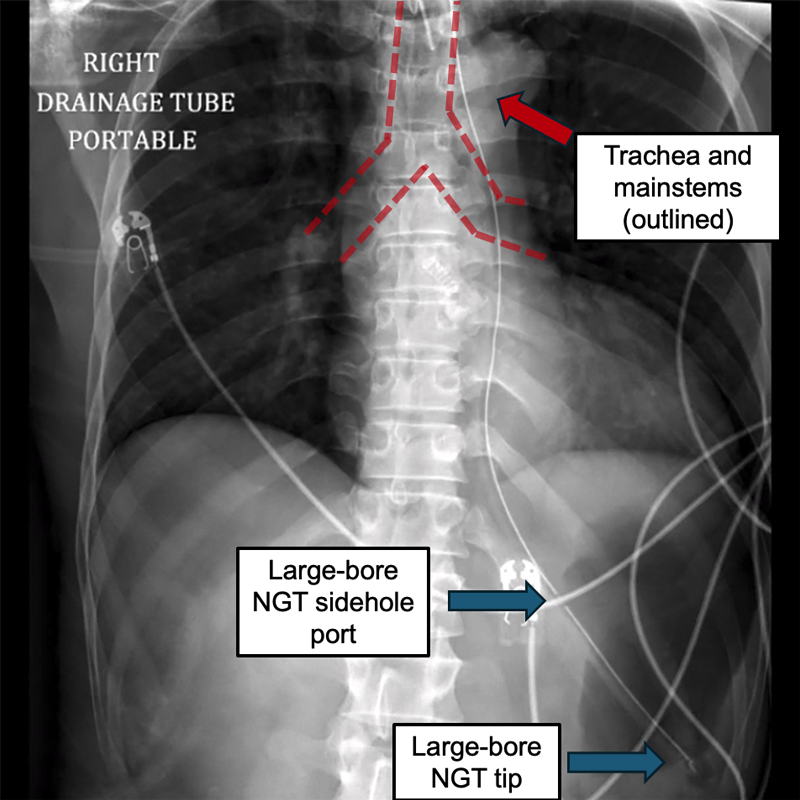 Annotated chest X-ray with NGT placed